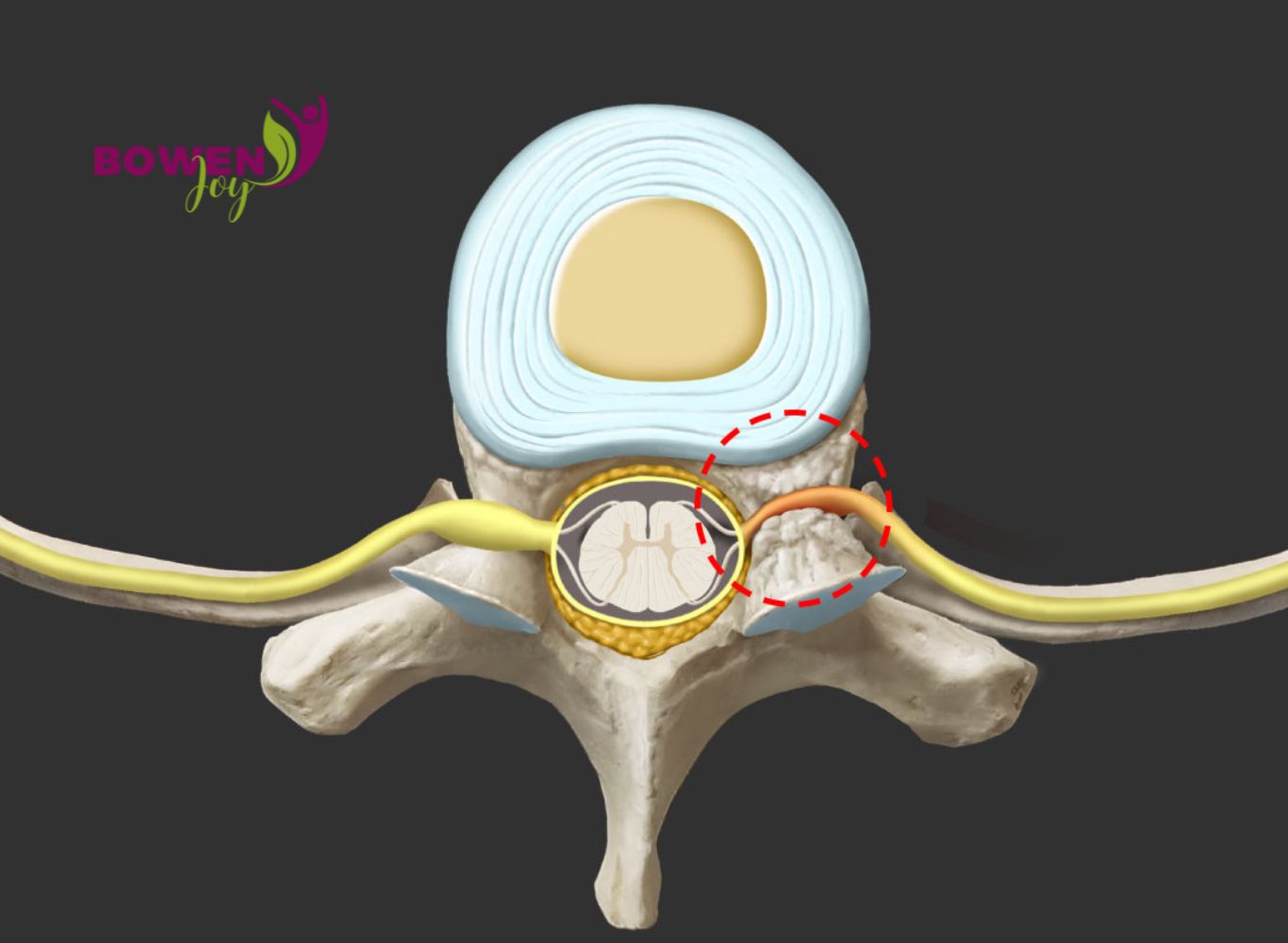 Hernia de disc și resetarea tensiunii miofasciale – rolul terapiei Bowen în recuperare